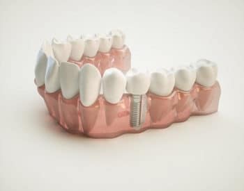 Dental Implants